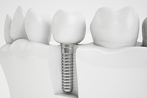 Animated implant retained crown