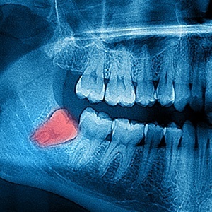 X-ray of wisdom teeth prior to wisdom tooth extraction