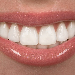 Closeup smile with porcelain dental crowns