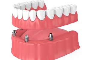 Animated all-on-4 dental implant denture placement