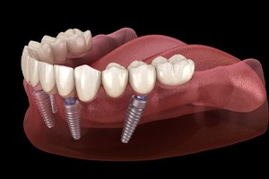 Animated all-on-4 dental implant placement