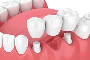 diagram of a traditional dental bridge