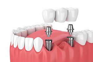 diagram of implant bridge