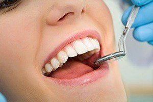 Closeup of smile during dental checkup after tooth colored filling treatment