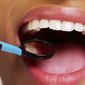 Closeup of smile during dental exam after tooth colored filling treatment