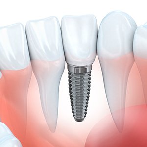 Animation of dental implant placement