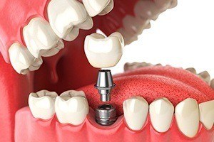 Animation of implant supported dental crown