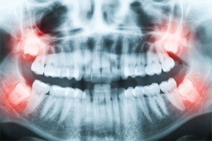 X-rays of wisdom teeth to plan wisdom tooth extractions