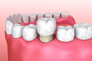 diagram of a dental crown