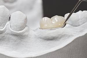 dental crown on a model of teeth