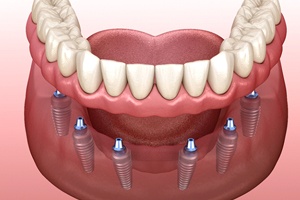 diagram of implant dentures