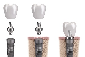parts dental implant