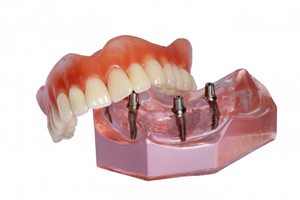 Model dental implant supported dentures