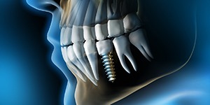 X-ray diagram of single tooth dental implant after placement
