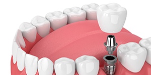 Diagram of single tooth dental implant in Lincoln