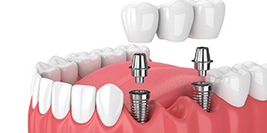 Diagram of dental implant bridge for multiple missing teeth in Lincoln
