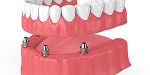 Diagram of dental implant dentures in Lincoln