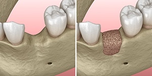 Diagram jawbone after bone grafting in Lincoln for dental implants