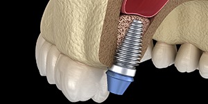 Diagram of dental implant after sinus lift in Lincoln