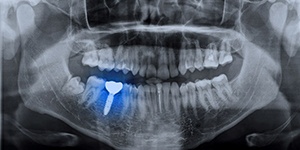 X-ray of dental implant after gum disease therapy in Lincoln