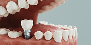 Animated dental implants supported dental crown placement