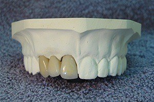 Model of smile with fixed bridge