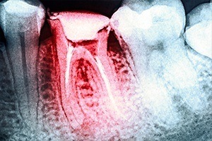 X-ray of root canal treated tooth