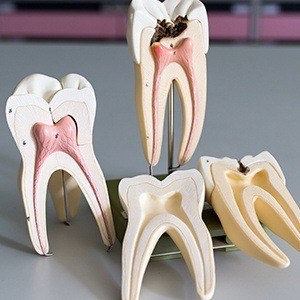 Model of inside of the tooth in need of root canal therapy