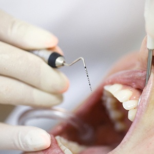 Periodontal therapy tool used for root planing