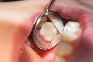 A closeup of a tooth with a tooth-colored filling