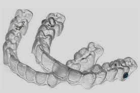 27-invisalign021914