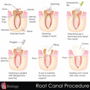 9-rootcanal062515