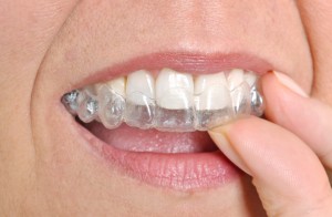 invisalign in lincoln