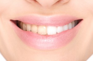 teeth whitening in Lincoln