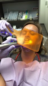A woman getting teeth whitening treatment.