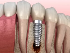 diagram of failing dental implant