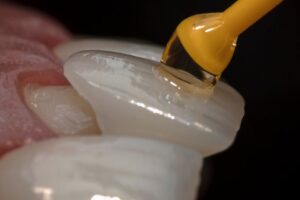closeup of a veneer being cemented onto a tooth