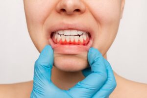 gloved hand showing a woman’s gums