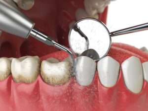 illustration of a professional teeth cleaning